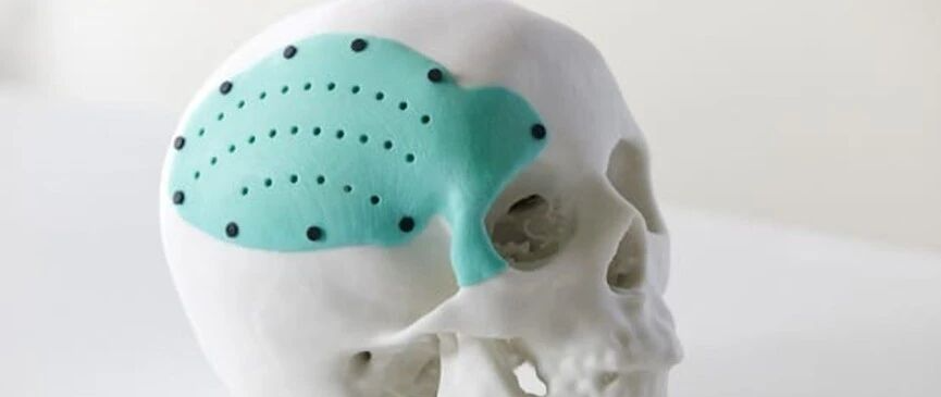 告别传统取模与漫长等待:医疗3D打印,终于走向质变时刻 | 深圳新造力